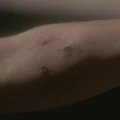Nesset bite.jpg
