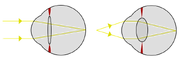 Focus in an eye