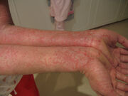 Eczema-arms
