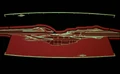 Ventral shield failure.jpg