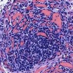 Kaposiform hemangioendothelioma