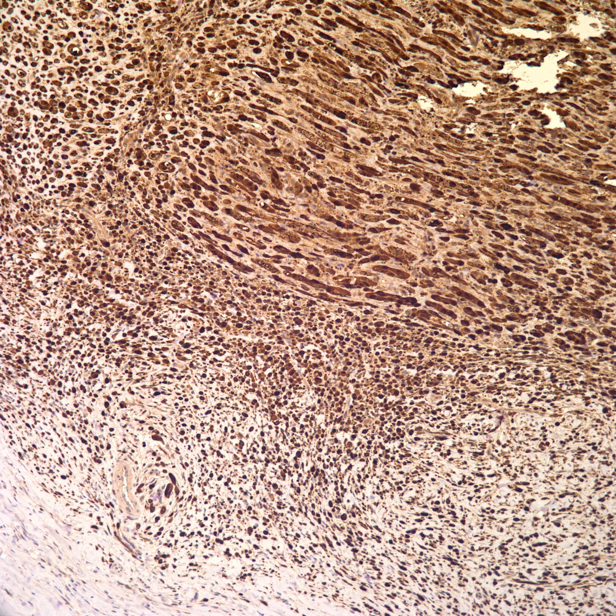 desmoplastic neurotropic melanoma