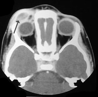 Langerhans cell histiocytosis - House Wiki