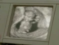Pregnancies